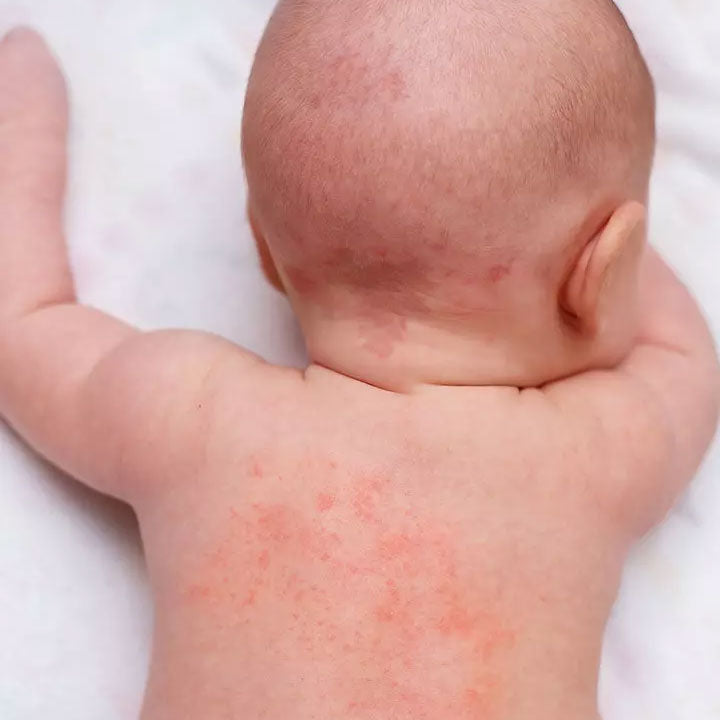 Heat Rash in Babies